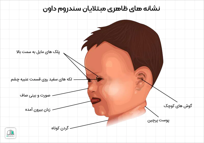 نشانه های سندروم داون