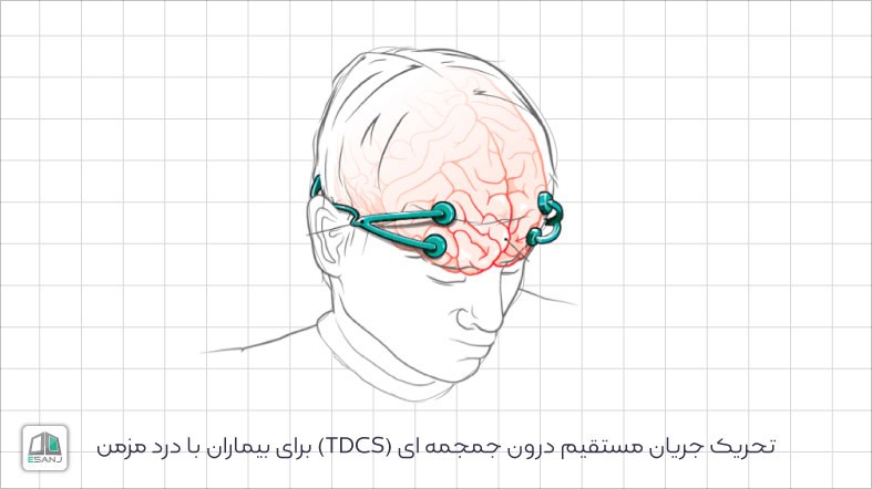 تحریک جریان مستقیم درون جمجمه ای (TDCS) برای بیماران با درد مزمن
